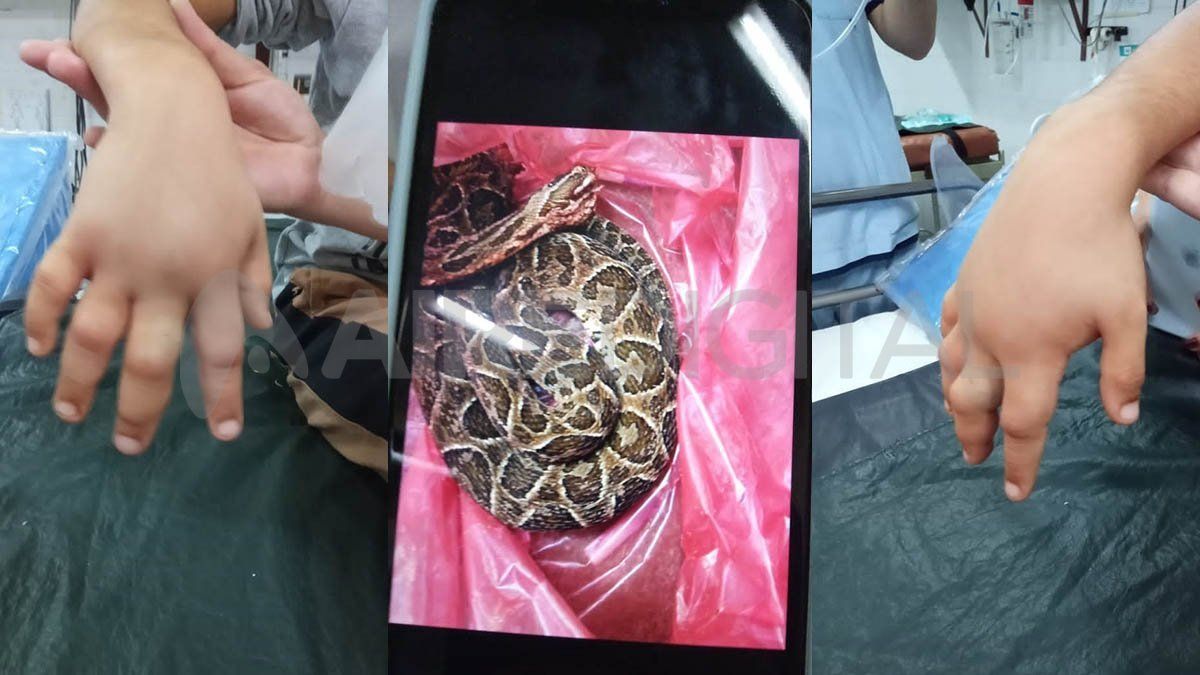 Operaron a Giovani, el niño mordido por una víbora Yarará en la Costanera de Santa Fe