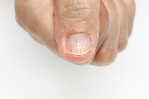 Las líneas verticales y horizontales en las uñas pueden indicar anemia y falta de vitaminas