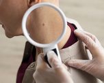La dermatóloga Luciana Cardellino advirtió que el cáncer de piel es el más frecuente a nivel mundial, pero también uno de los más prevenibles. La dermatóloga Luciana Cardellino advirtió que el cáncer de piel es el más frecuente a nivel mundial, pero también uno de los más prevenibles.