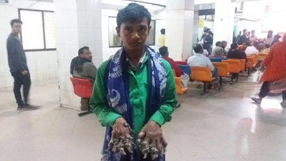 El “hombre árbol” abandonó su tratamiento y las “ramas” volvieron a crecer: “Quiero vivir como una persona normal”