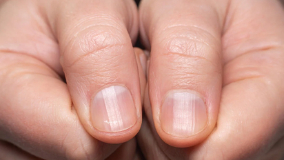 Qué enfermedades pueden significar las uñas rayadas