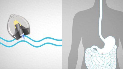 Desarrollan un píldora que inyecta una dosis de insulina desde el estómago