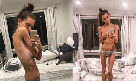 Sorprendente recuperación de una mujer con anorexia que pesaba 30 kilos