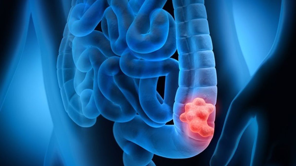 El cáncer de colon y recto es un tumor maligno que se desarrolla en la última parte del tubo digestivo&nbsp;