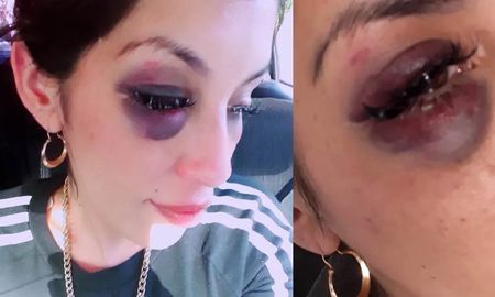Su expareja la atacó tres veces en una semana y le desfiguró la cara: Su expareja la atacó tres veces en una semana y le desfiguró la cara: