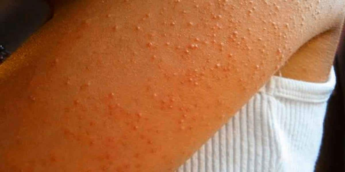 Cómo quitar los molestos granitos de brazos y pies que parecen acné pero no lo son