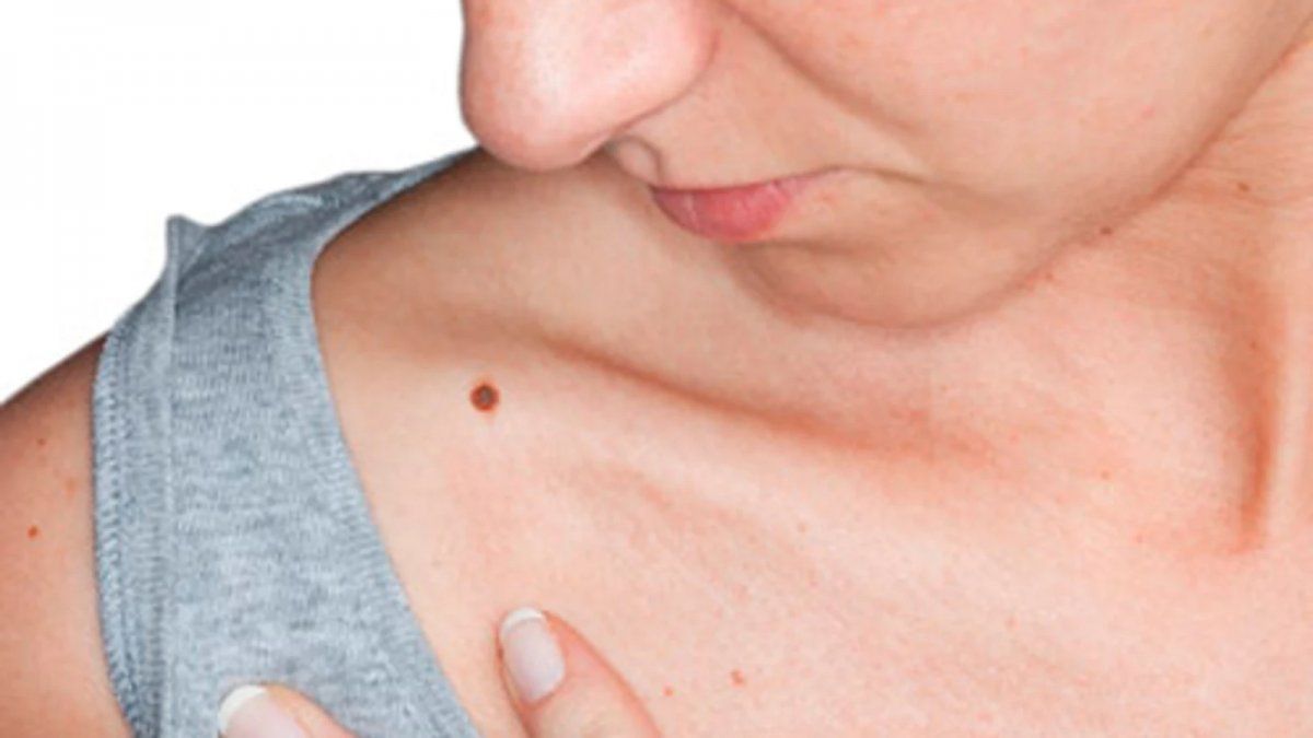 Consejos para evitar la aparici&oacute;n de manchas solares en verano