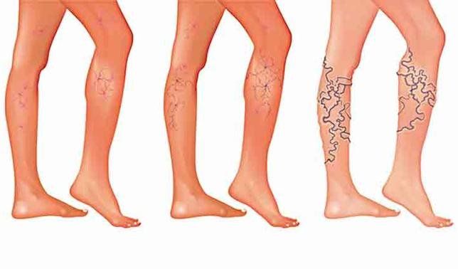 Cómo prevenir las varices