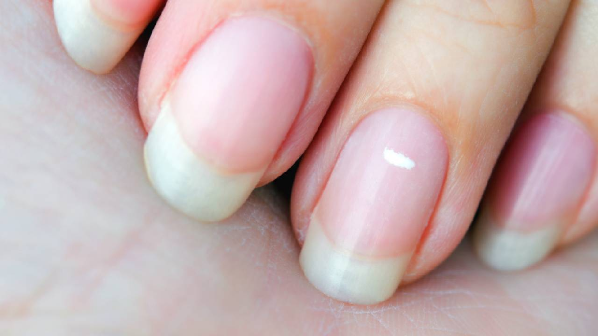 Las manchas blancas en las uñas suelen ser por exceso de calcio. Las manchas blancas en las uñas suelen ser por exceso de calcio.