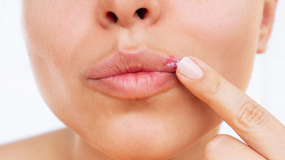 Herpes labial: qué lo causa y cómo aliviar el dolor