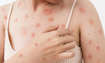 La viruela del mono se transmite principalmente a través del contacto físico cercano, particularmente durante la actividad sexual. La viruela del mono se transmite principalmente a través del contacto físico cercano, particularmente durante la actividad sexual.