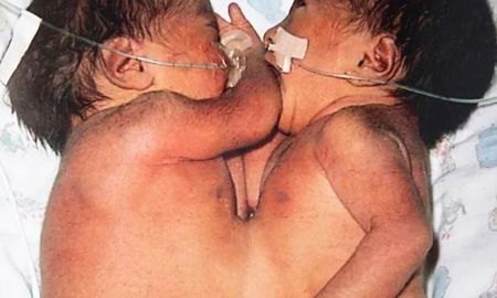 La increíble historia de unas gemelas que nacieron “pegadas”, crecieron separadas y ahora viven juntas como “las mejores amigas”