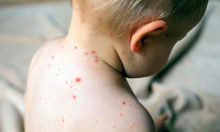 Alerta nacional por casos de sarampión
