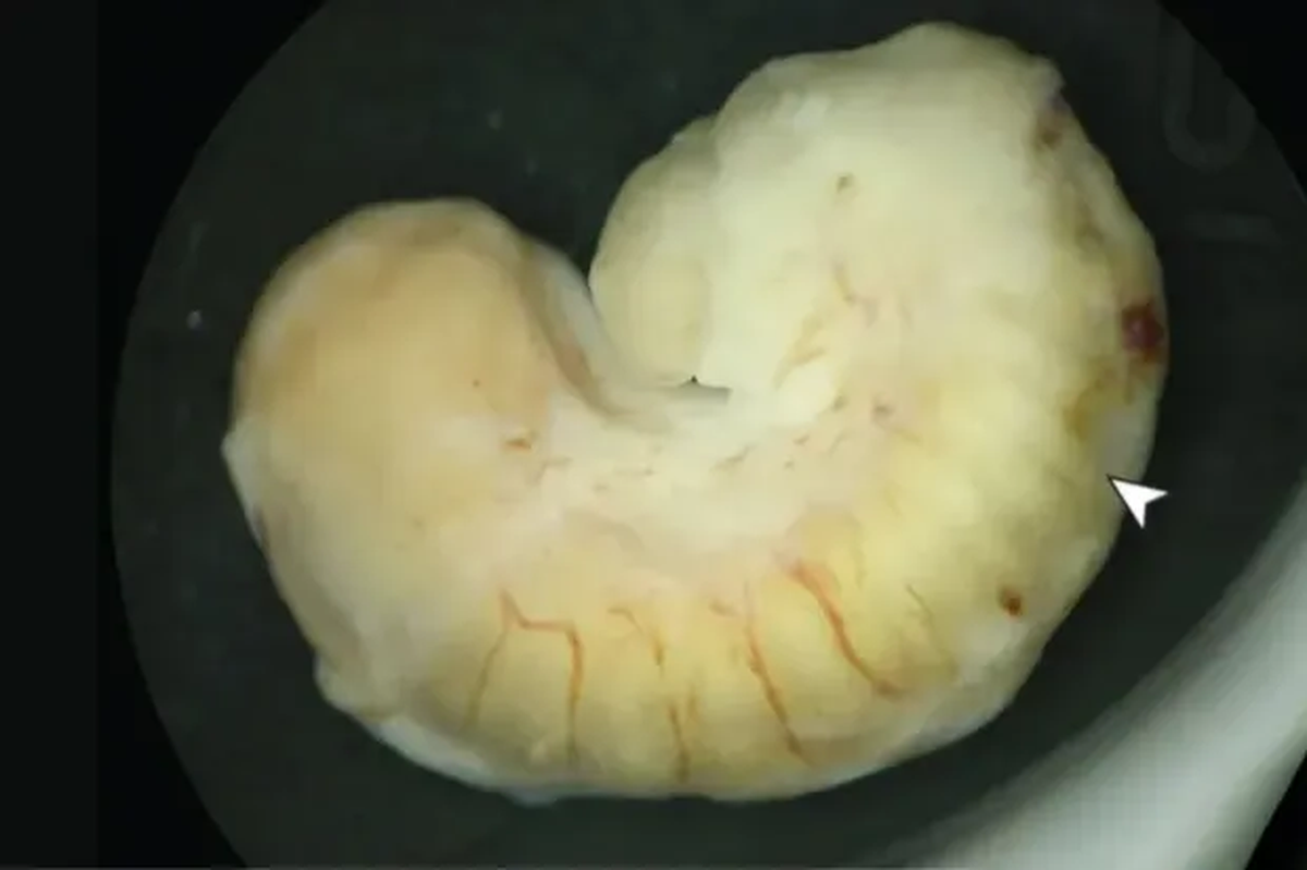El parásito extraído del ojo de la mujer. El parásito extraído del ojo de la mujer.