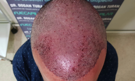 era pelado, viajo para hacerse un trasplante de pelo, se descompenso en plena operacion y no pudieron revivirlo era pelado, viajo para hacerse un trasplante de pelo, se descompenso en plena operacion y no pudieron revivirlo