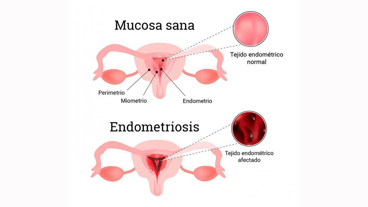 La endometriosis es una de las principales causas de infertilidad que afecta a más de 170 millones de mujeres. Es una enfermedad de la que poco se sabe pero cuyos síntomas pueden tomarse como algo normal. 