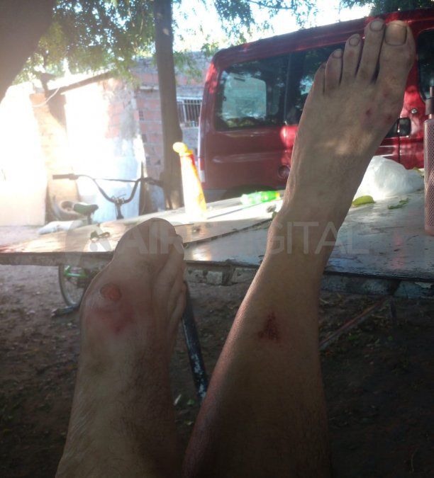 Las lesiones en los pies de Costanzo.