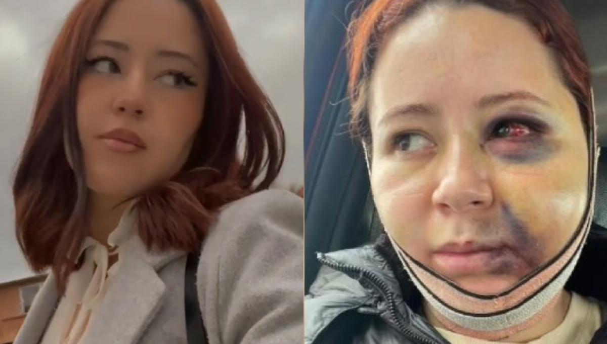 Se hizo una bichectomía en una estética y terminó con la cara desfigurada