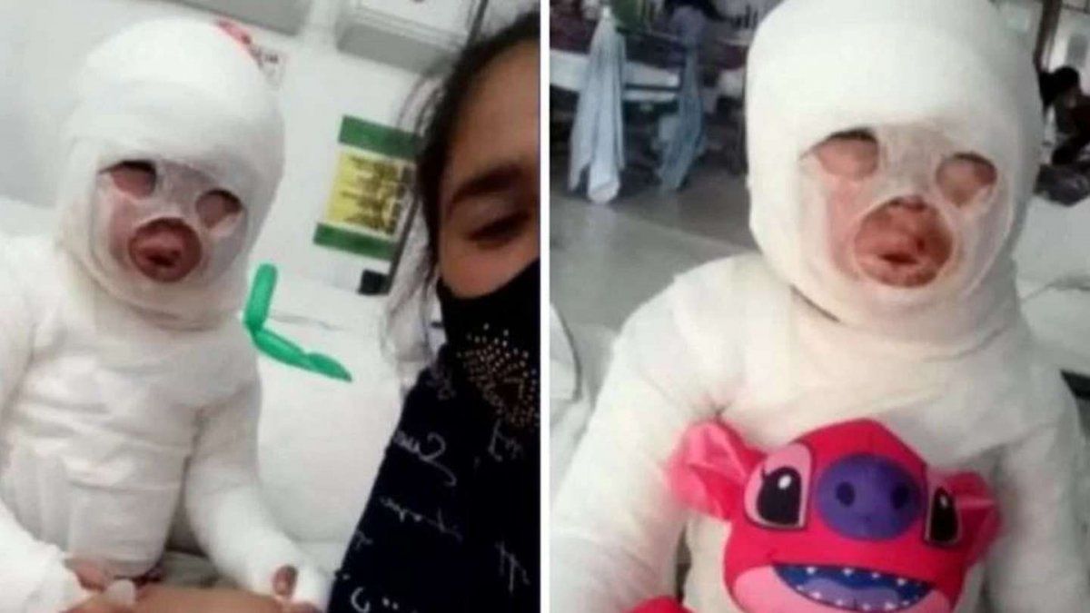 Quemaron con aceite hirviendo a una nena de tres años en un restaurante de Florencio Varela