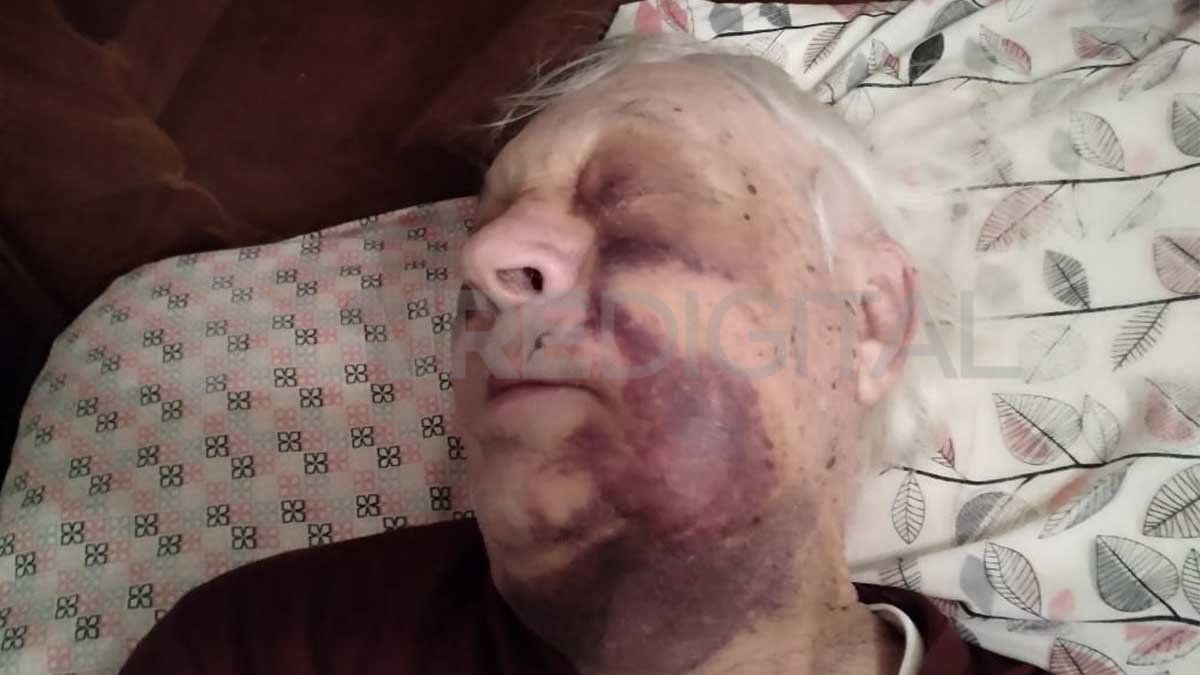 Así le quedó el rostro a Remigio luego de la golpiza: el abuelo tiene problemas de coagulación