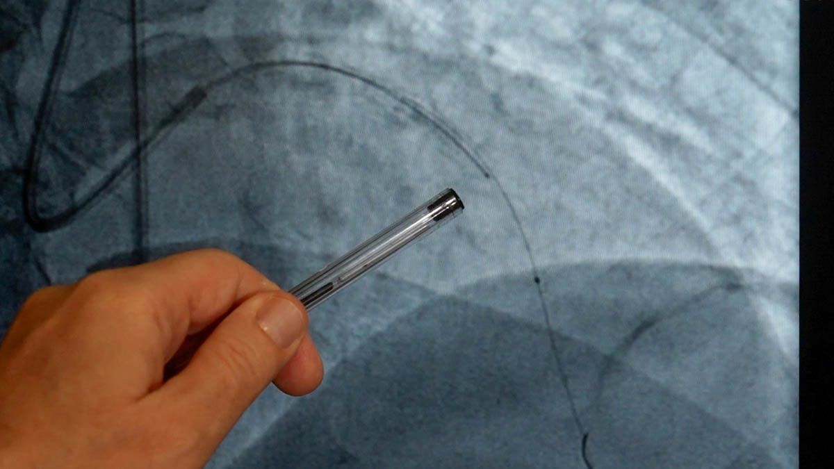 Las arterias no son tubos rectos, tienen ramas y particularidades anatómicas que aumentan la dificultad del procedimiento. Las arterias no son tubos rectos, tienen ramas y particularidades anatómicas que aumentan la dificultad del procedimiento.