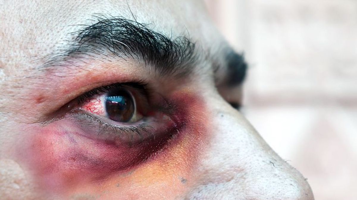 &nbsp;Esta extraña enfermedad surgió en los últimos meses alrededor del mundo y ataca con más gravedad a quienes padecen o padecieron coronavirus.