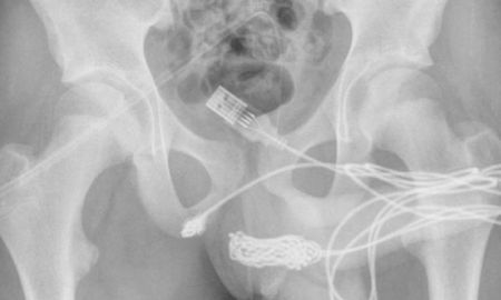 Un chico intentaba medir su miembro y se le enredó un cable USB en la uretra: tuvieron que operarlo Un chico intentaba medir su miembro y se le enredó un cable USB en la uretra: tuvieron que operarlo