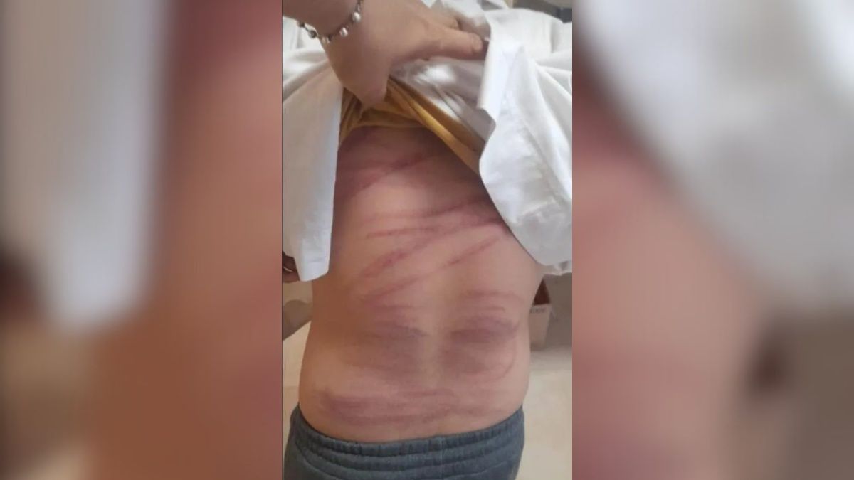 El menor necesita 26 días para recuperarse. El menor necesita 26 días para recuperarse. 