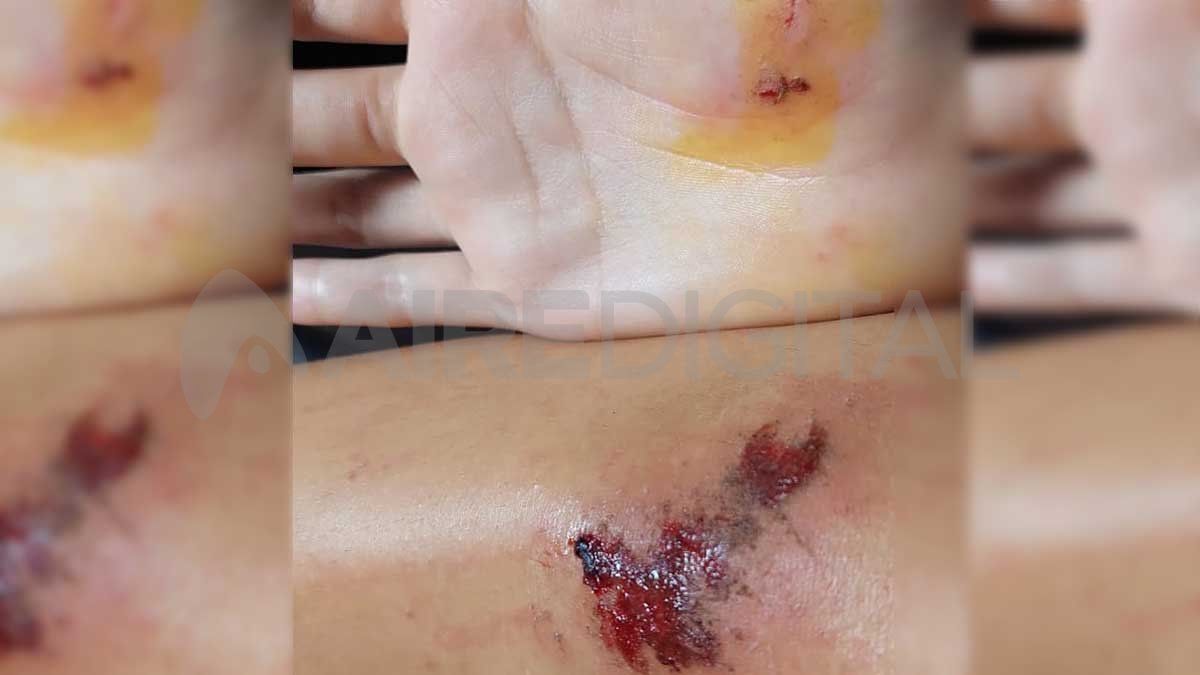 Las manos y las piernas de Abigail quedaron lastimadas por el ataque.