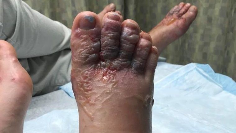 Fueron a Punta Cana y volvieron con un parásito que “comió” sus pies