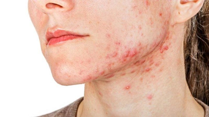 acne e1548952200781.jpg