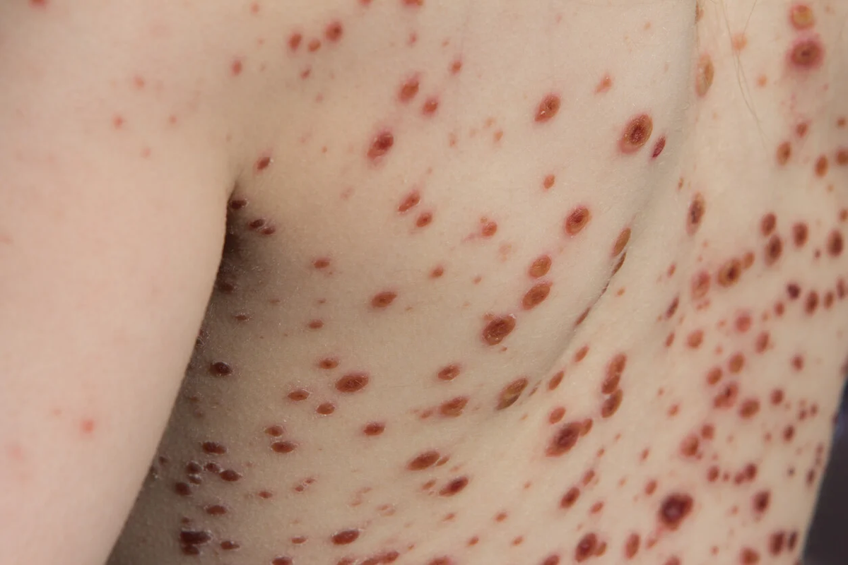 El Dr. Befani subraya que, aunque la viruela del mono no es tan contagiosa como el COVID-19. El Dr. Befani subraya que, aunque la viruela del mono no es tan contagiosa como el COVID-19.