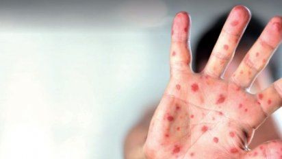 Alarma por un brote récord de sarampión en Europa