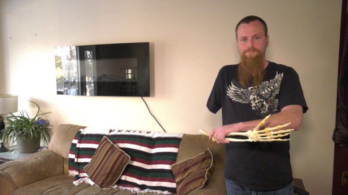 Le amputaron el brazo y decidió conservar el esqueleto