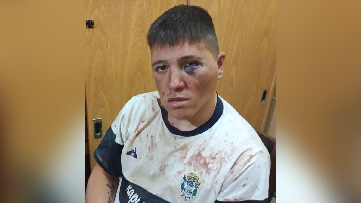 Uno de los jóvenes atacados en Esperanza sufrió fuertes lesiones en gran parte de su cuerpo.