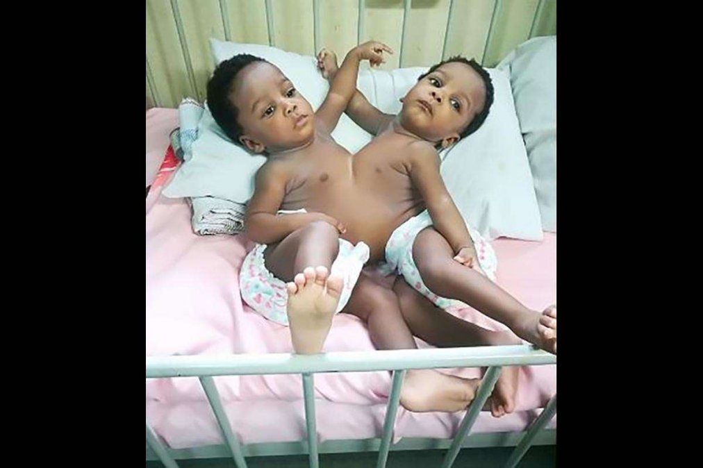 Siamesas nigerianas fueron separadas tras la participación de 78 médicos