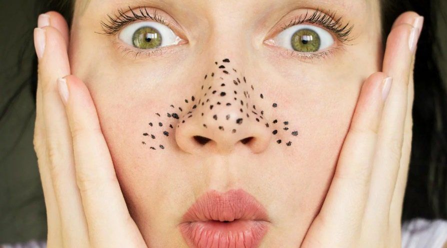 Puntos negros en la nariz: guía básica para prevenirlos y eliminarlos