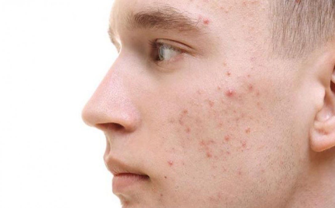 El efecto milagro de los probióticos en el acné