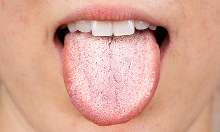 lengua blanca, seca o con manchas: que puede indicar lengua blanca, seca o con manchas: que puede indicar