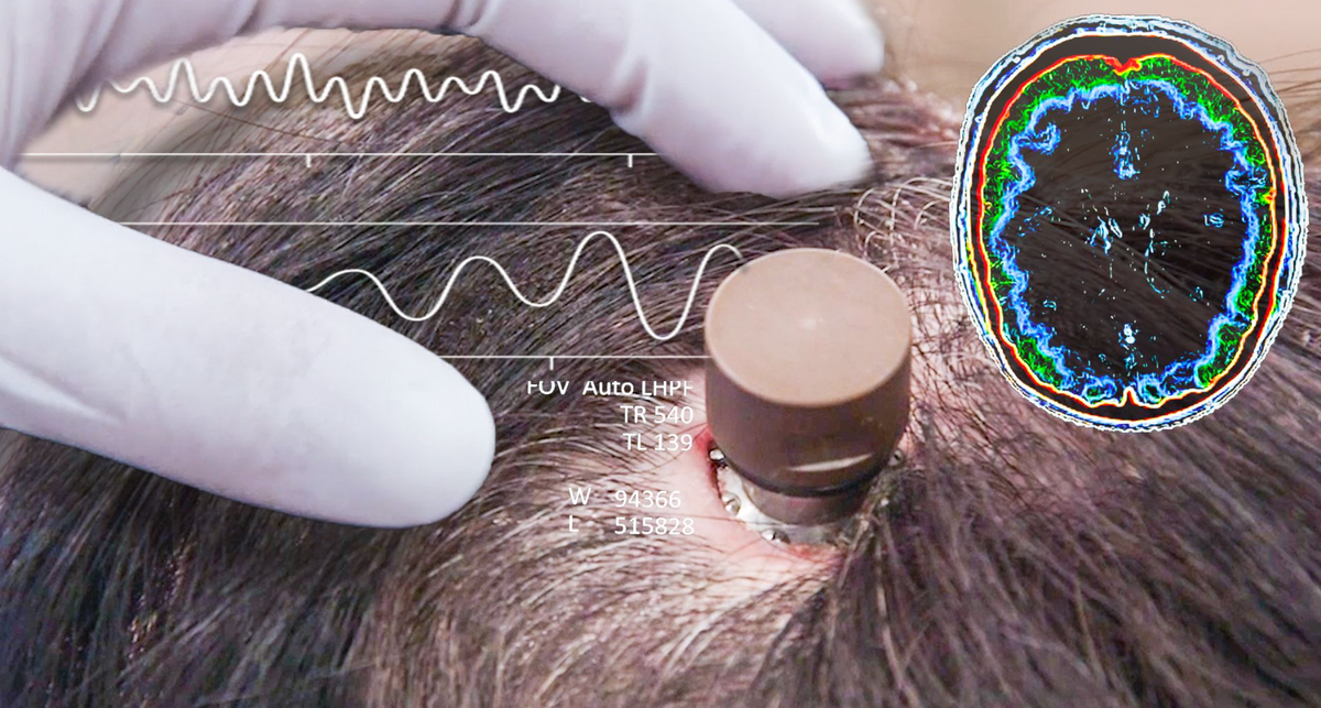 El implante del chip pudo ser posible después de dos años de haber sido anunciado. El implante del chip pudo ser posible después de dos años de haber sido anunciado.