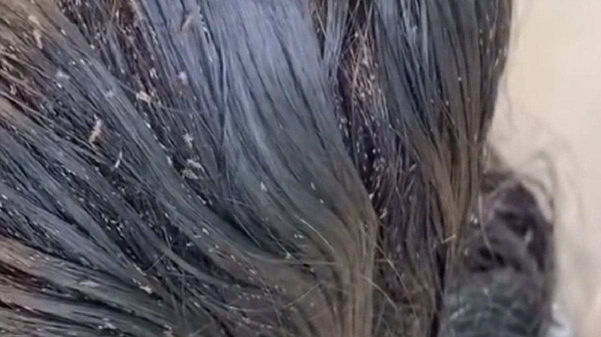 No apto para impresionables: una niña tenía 15 mil piojos en la cabeza&nbsp;