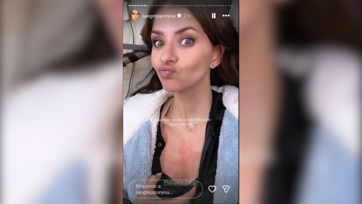 A través de una historia de Instagram, la China Suárez mostró la quemadura que sufrió mientras grababa en la Patagonia. A través de una historia de Instagram, la China Suárez mostró la quemadura que sufrió mientras grababa en la Patagonia.
