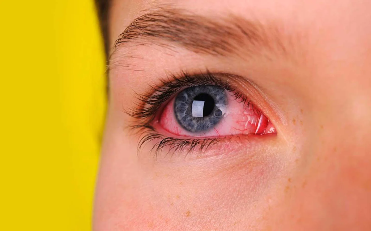 Fiebre Hemorrágica Argentina: qué es