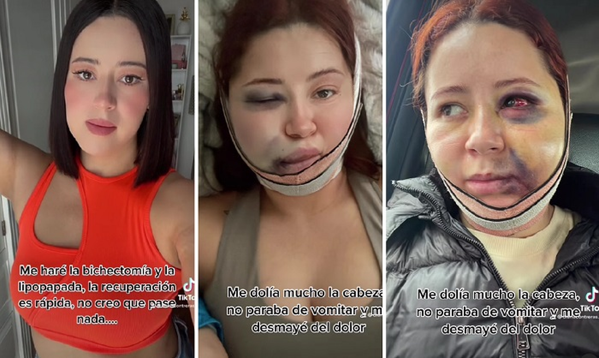 Diana Contreras sufrió los efectos adversos de una bichectomía.