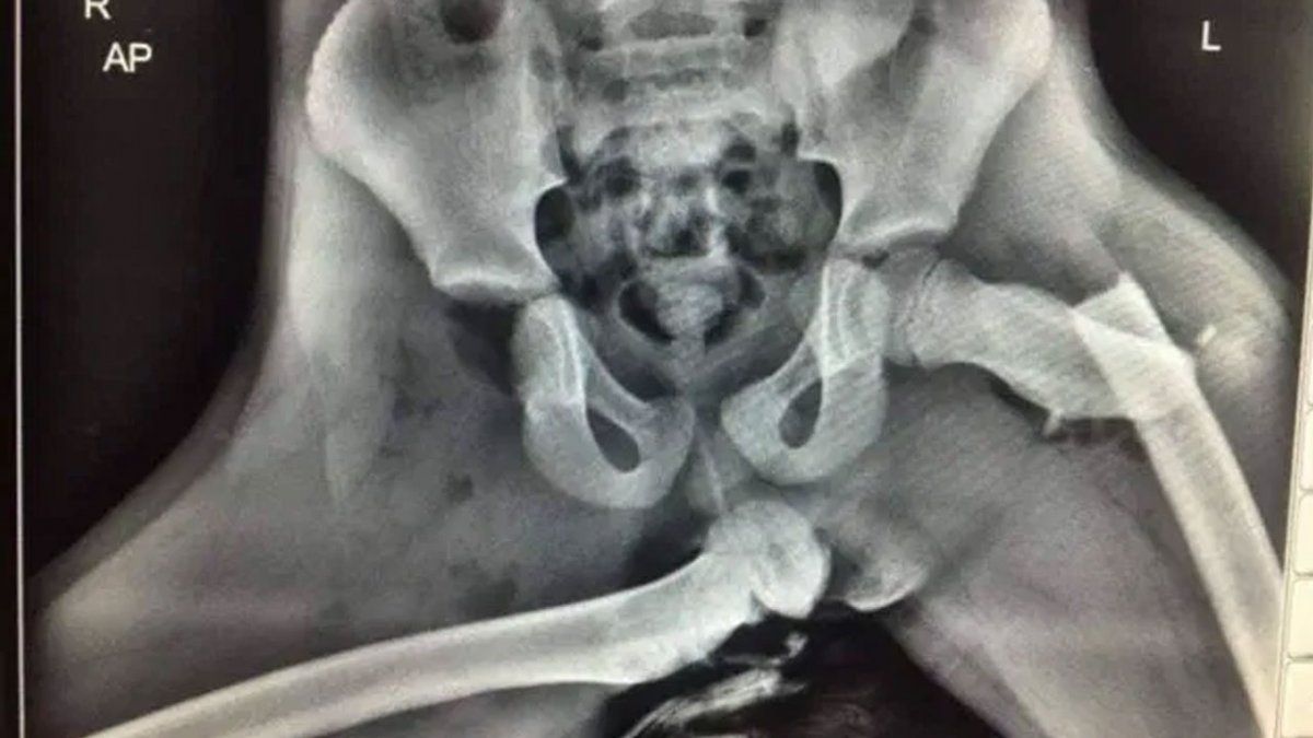 Imágenes sensibles: Sufrieron un accidente y se fracturó la cadera por tener los pies arriba del tablero