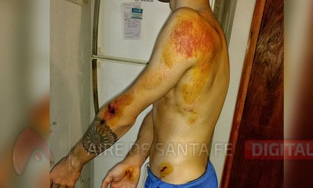un bache provoco un accidente en costanera: ?la bicisenda estaba ocupada por autos? un bache provoco un accidente en costanera: ?la bicisenda estaba ocupada por autos?