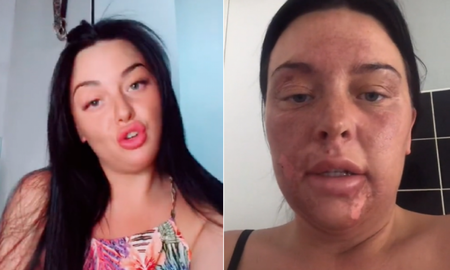 Chantelle confesó que no podrá exponerse por 1 año al sol. Chantelle confesó que no podrá exponerse por 1 año al sol.