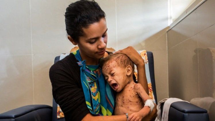 Advirtieron que los ni&ntilde;os pueden enfrentarse a desnutrici&oacute;n aguda a causa de la pandemia del coronavirus.&nbsp;