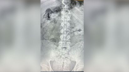 Ceres: dos personas fueron detenidas en un control en la Ruta Nacional 34 con más de 160 cápsulas de cocaína dentro de sus cuerpos