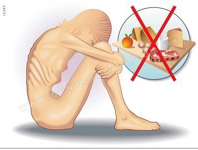 Anorexia, qué es y qué hacer frente a los primeros síntomas